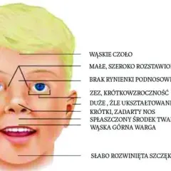 Zespół FAS: Niepokojące objawy, które musisz znać i rozumieć