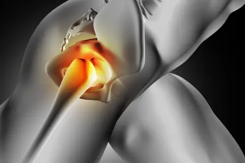 Bolesne zapalenie krętarza biodra: objawy, które musisz znać