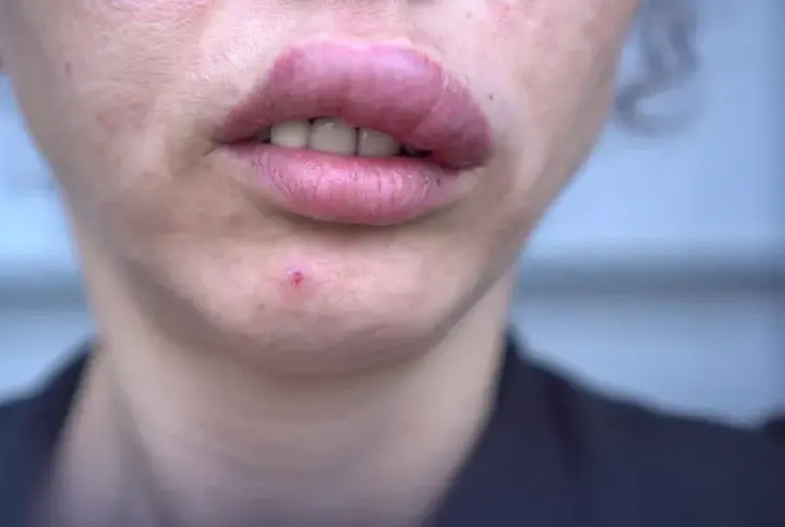 Alergia na sezam: 5 objawów które powinny cię zaniepokoić