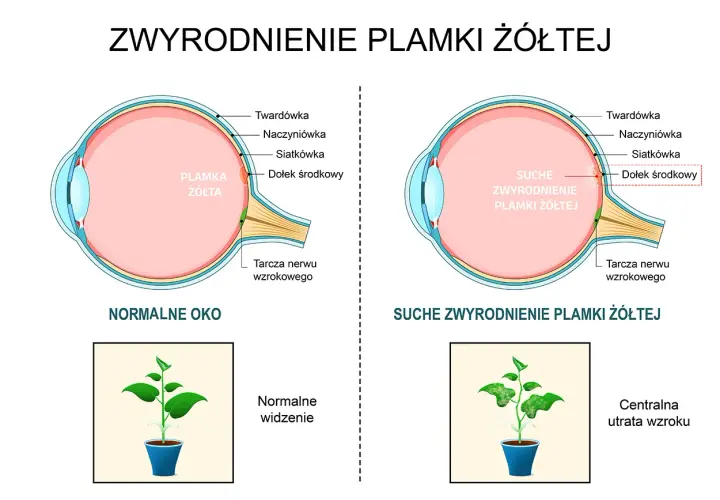 Zwyrodnienie plamki żółtej: objawy, które musisz znać, zanim będzie za późno
