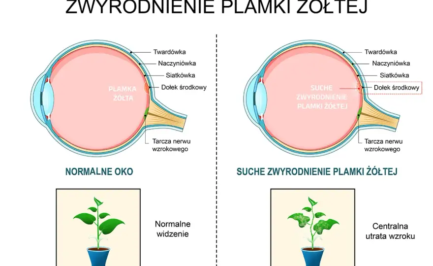 Zwyrodnienie plamki żółtej: objawy, które musisz znać, zanim będzie za późno